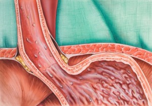 Le reflux gastro-œsophagien - Gastro - entérologues